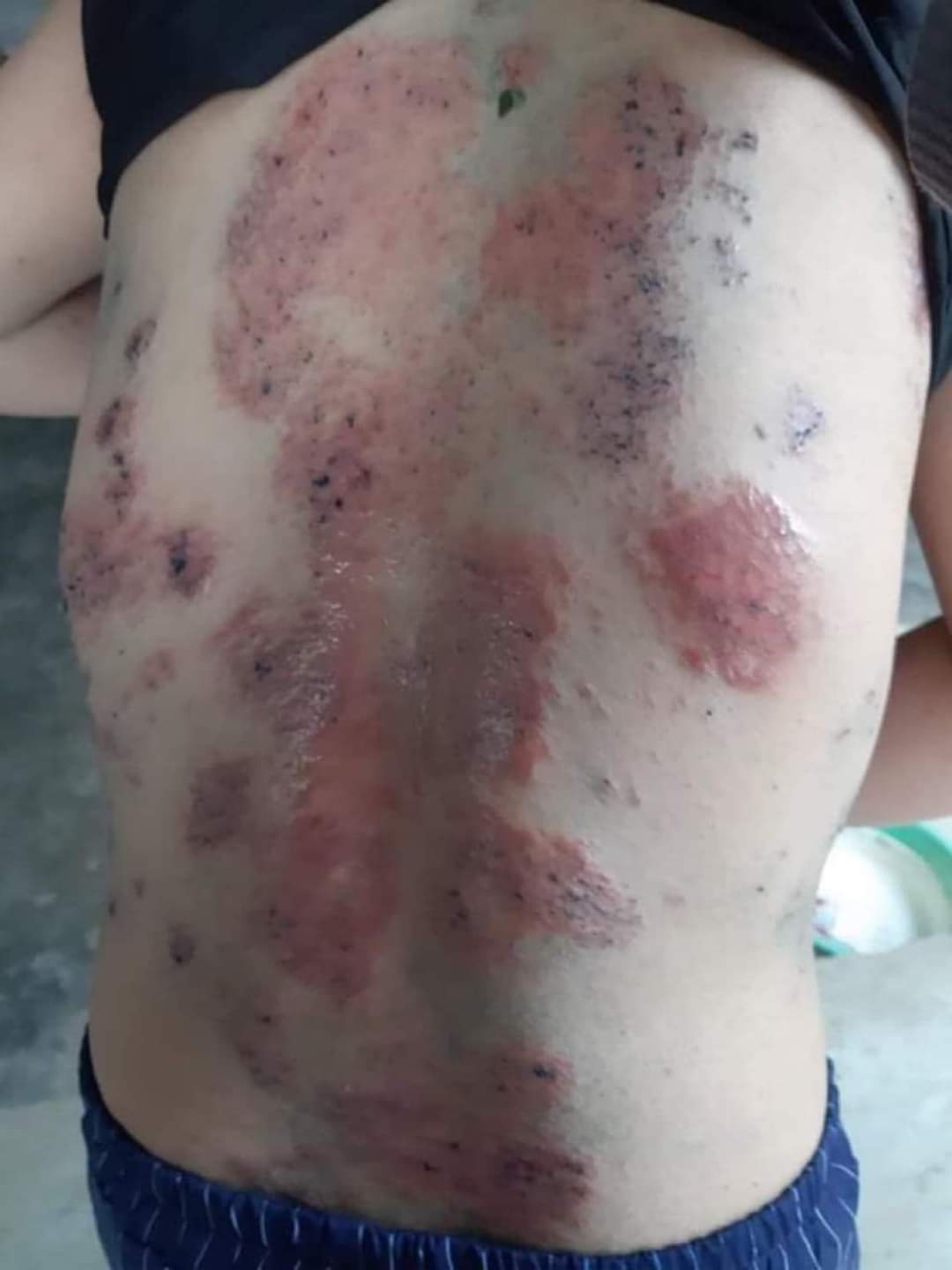 Điều trị viêm da cơ địa – Khuẩn nấm axit